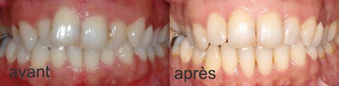 Resultat traitement aerodontis femme 40 ans