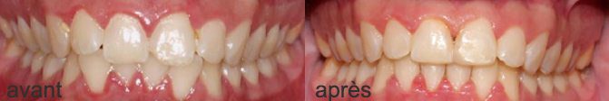 résultat traitement aerodontis homme 17 ans