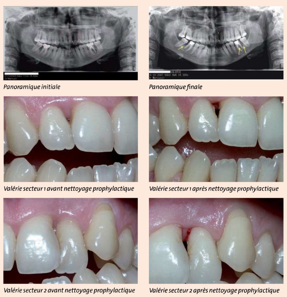 Cas clinique Vector Paro Dürr Dental