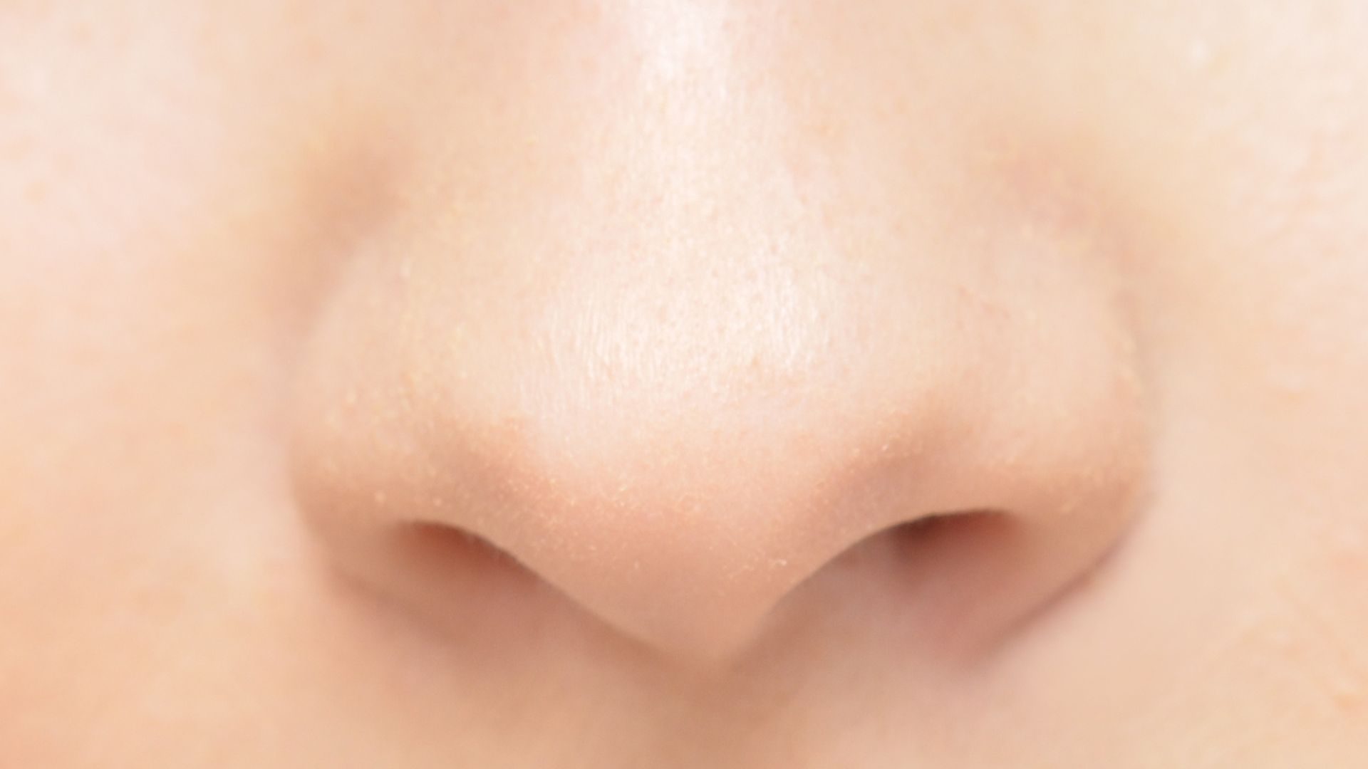 Cas d'une dent ectopique dans la cavité nasale