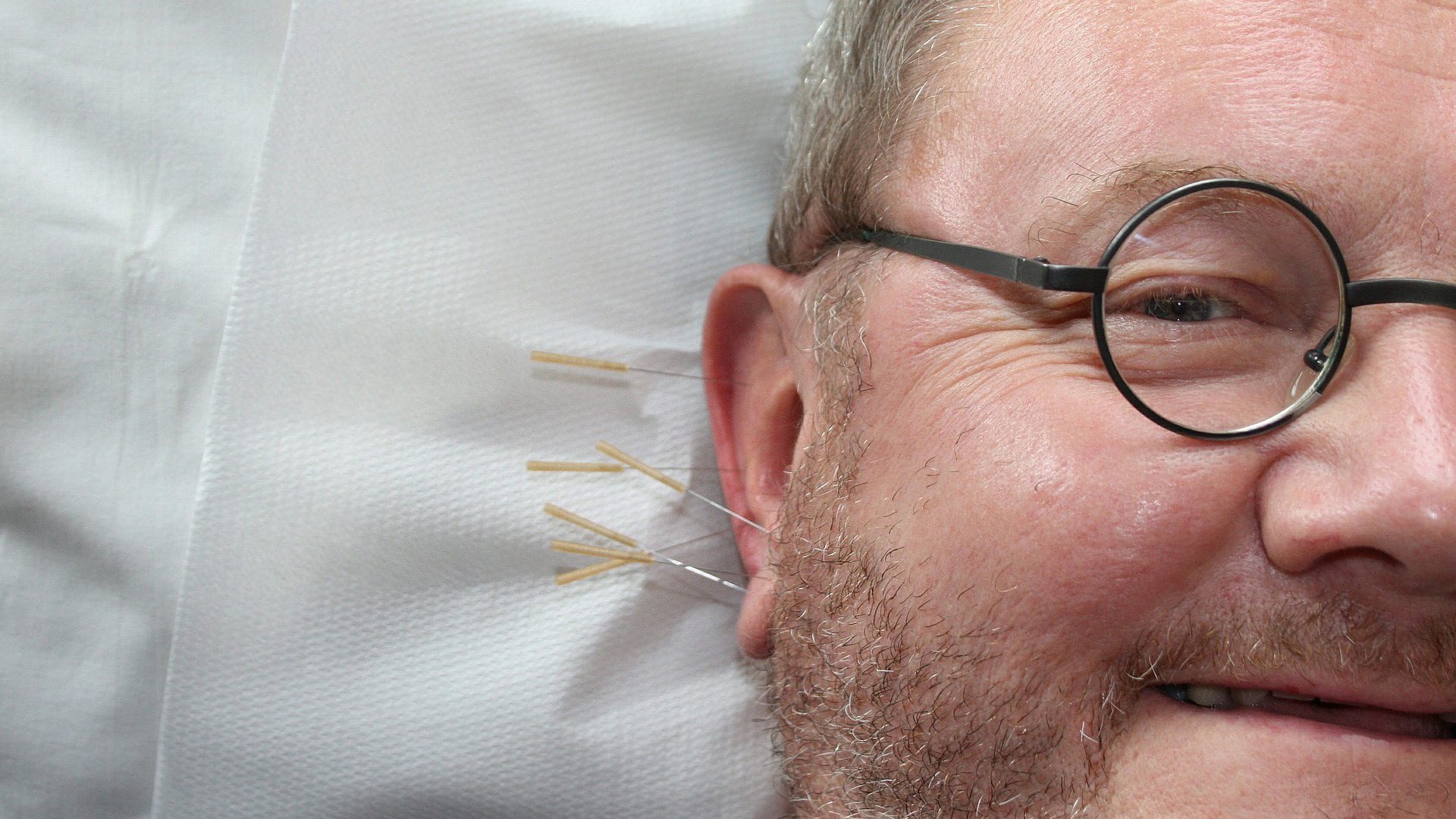 acupuncture-ANXIETE_DENTAIRE