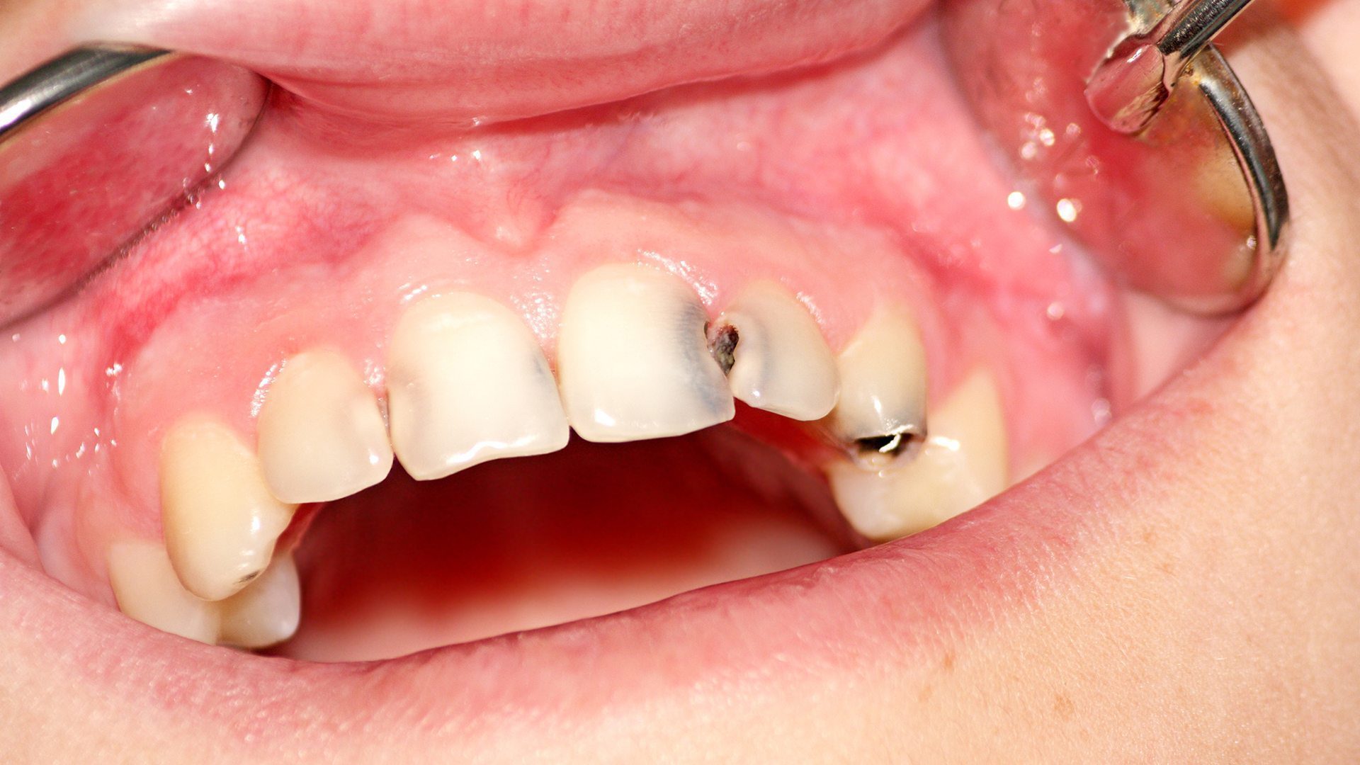 medicament-contre-alzheimer-carie-dentaire