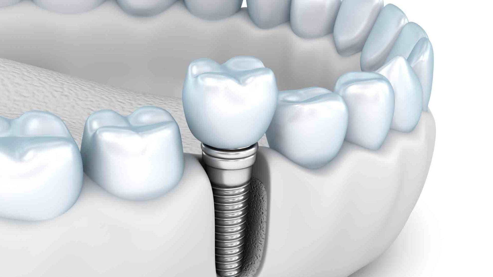 Remboursement implants dentaires en France recommandation HAS
